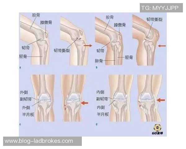 足球压膝盖的危害与预防措施探讨如何保护运动员的膝关节健康